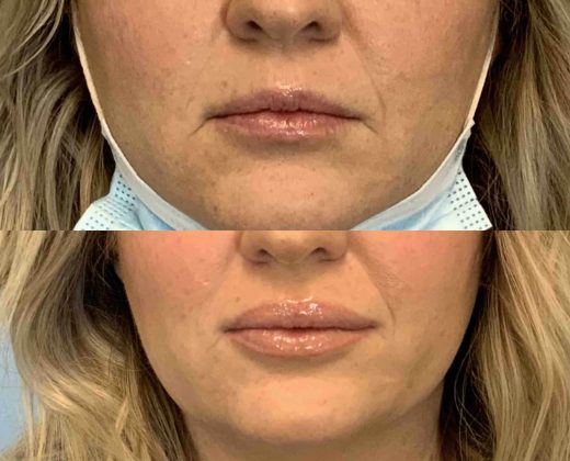 Before and after, patient 10 days post op from Lip Filler procedure performed by Dr. Paul Vanek