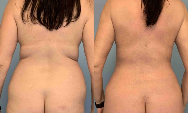 Before and after, patient 1 yr post op from VASER Renuvion Abdomen, Tummy Tuck, Flanks, Mons Thighs, Brazilian Butt Lift, Breast Augmentation, Level III Muscle Release procedures performed by Dr. Paul Vanek