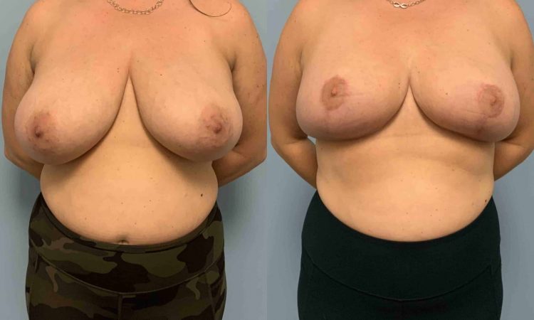 Before and after, patient 5 mo post op from Breast Reduction, Axillary Roll Resection, VASER Axilla procedures performed by Dr. Paul Vanek