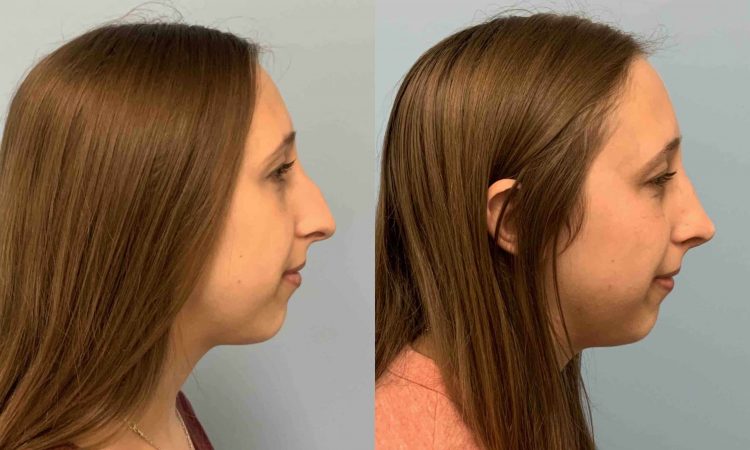 Before and after, patient 9 mo post op from Rhinoplasty and Septoplasty procedures performed by Dr. Paul Vanek