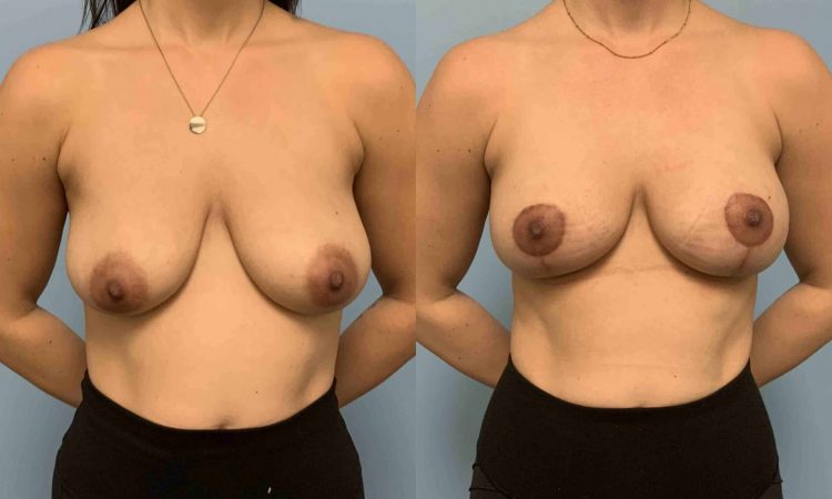 Before and after, patient 1 mo post op from Breast Lift, Wise Pattern Mastopexy procedures performed by Dr. Paul Vanek