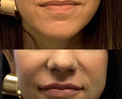 Before and after, patient same day after Lip Augmentation w/Filler procedures performed by Dr. Paul Vanek