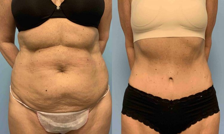 Before and after, 10 mo post op from Tummy Tuck, VASER Abdomen, Flanks, and Mons performed by Dr. Paul Vanek (front view)