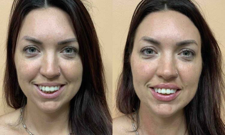 Before and after, patient same day after Fillers – Cheeks, Lips, and Jaw performed by Dr. Paul Vanek