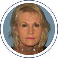 Photo of a blonde woman before facelift staring at the camera represented on Mentor Plastic Surgery and MedSpa