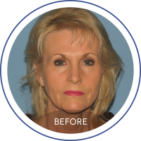 Photo of a blonde woman before facelift staring at the camera represented on Mentor Plastic Surgery and MedSpa