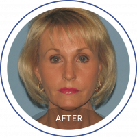 Photo of a blonde woman after facelift staring at the camera represented on Mentor Plastic Surgery and MedSpa