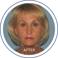 Photo of a blonde woman after facelift staring at the camera represented on Mentor Plastic Surgery and MedSpa