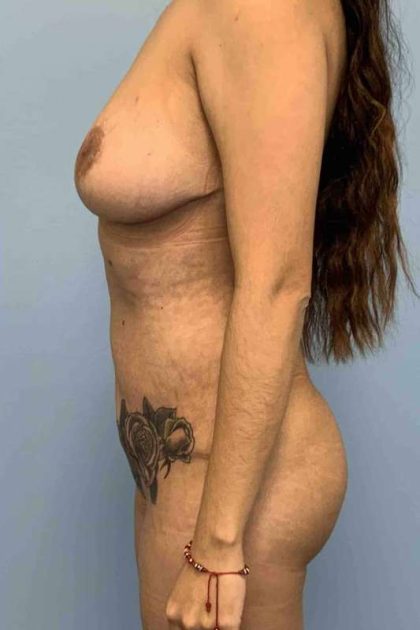 Tummy Tuck Before & After Patient #10703