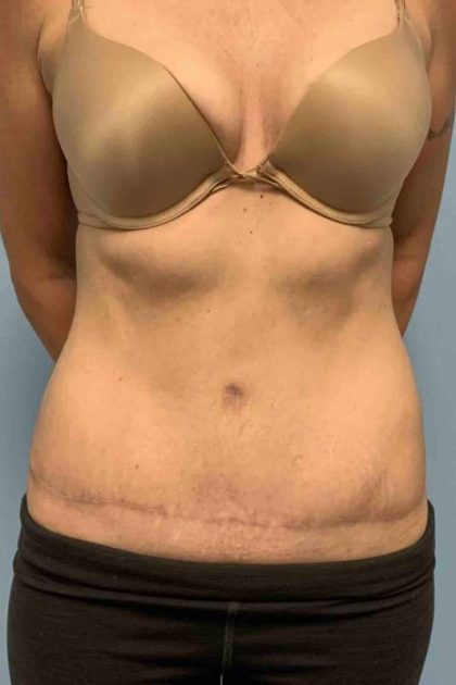 Tummy Tuck Before & After Patient #10721