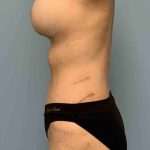 Tummy Tuck Before & After Patient #10733