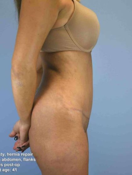 Tummy Tuck Before & After Patient #10742