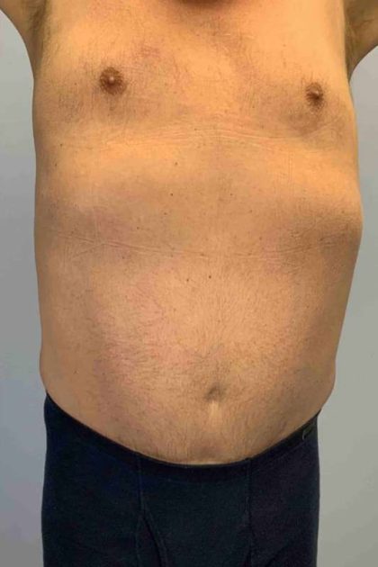 Tummy Tuck Before & After Patient #10749