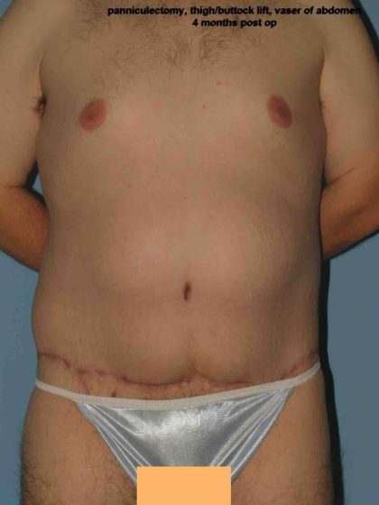 Tummy Tuck Before & After Patient #10774