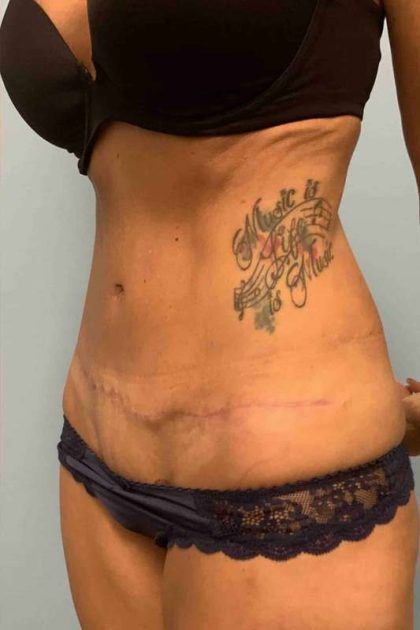 Tummy Tuck Before & After Patient #10779