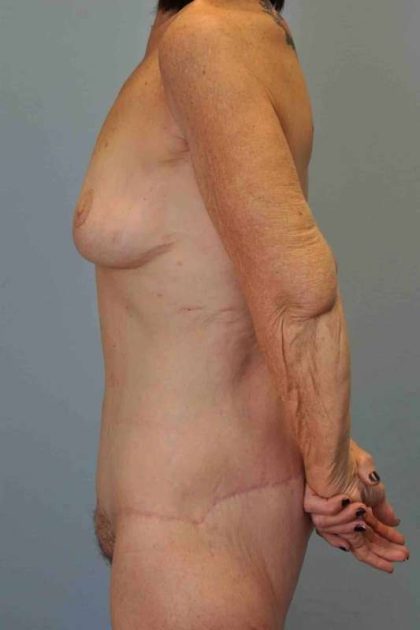 Tummy Tuck Before & After Patient #10793