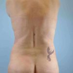 VASER Liposelection Before & After Patient #10384