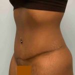 Tummy Tuck Before & After Patient #10839