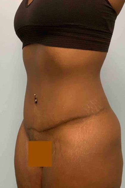 Tummy Tuck Before & After Patient #10839