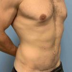 Tummy Tuck Before & After Patient #10846