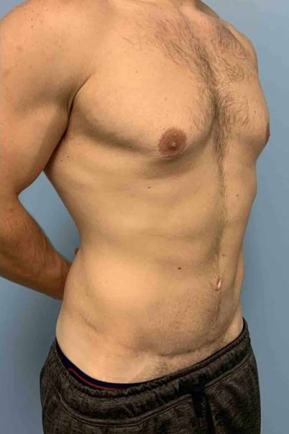 Tummy Tuck Before & After Patient #10846