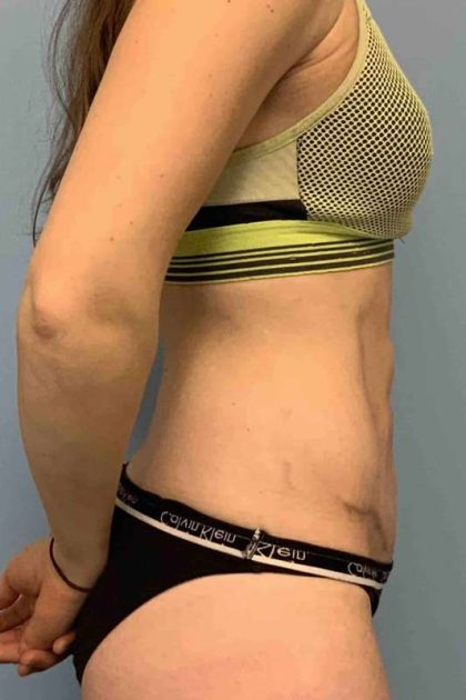 Tummy Tuck Before & After Patient #10862
