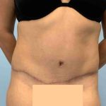 Tummy Tuck Before & After Patient #10869
