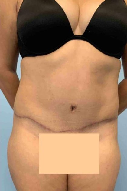 Tummy Tuck Before & After Patient #10869