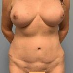 Tummy Tuck Before & After Patient #10874