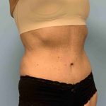 Tummy Tuck Before & After Patient #10881