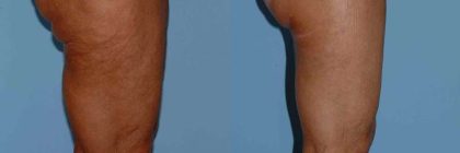 Thigh Surgery Before & After Patient #10890