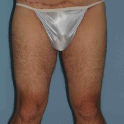 Thigh Surgery Before & After Patient #10893