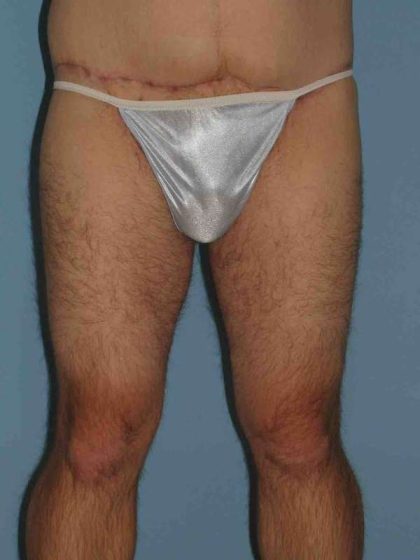 Thigh Surgery Before & After Patient #10893