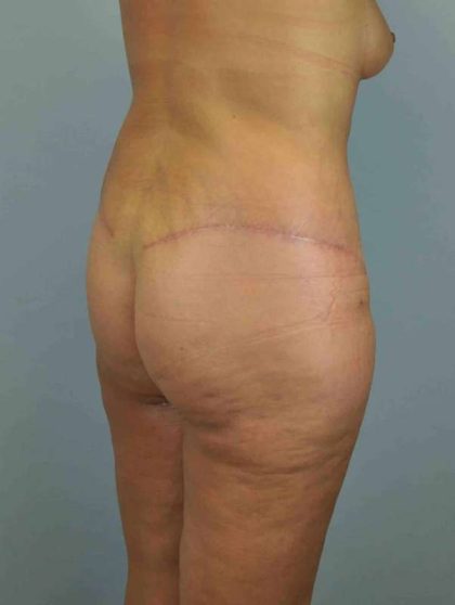 Thigh Surgery Before & After Patient #10900
