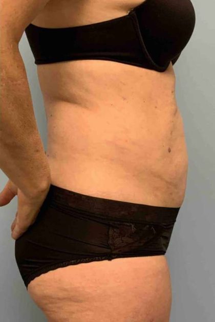 Renuvion Before & After Patient #10921