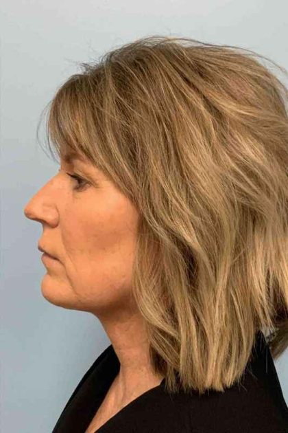 Renuvion Before & After Patient #10971