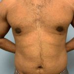 Renuvion Before & After Patient #10978