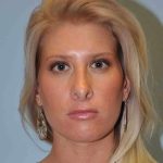 Nose Surgery Before & After Patient #10990