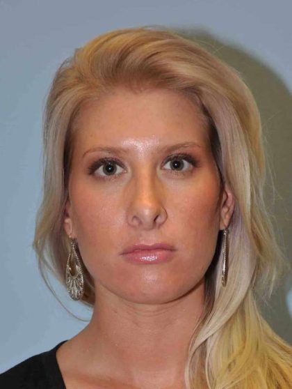 Nose Surgery Before & After Patient #10990