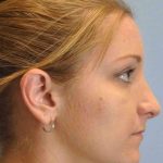 Nose Surgery Before & After Patient #10997