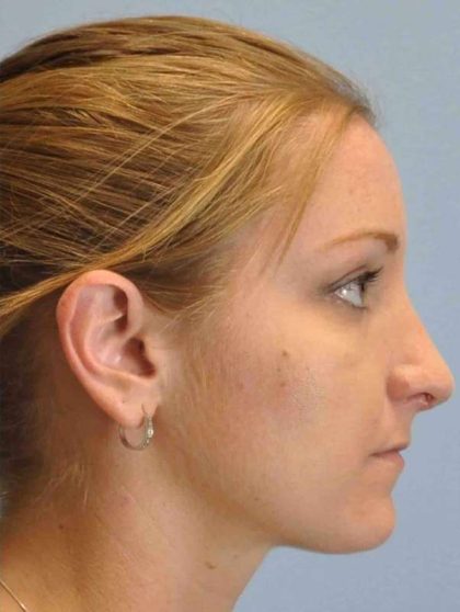 Nose Surgery Before & After Patient #10997