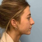 Nose Surgery Before & After Patient #11004