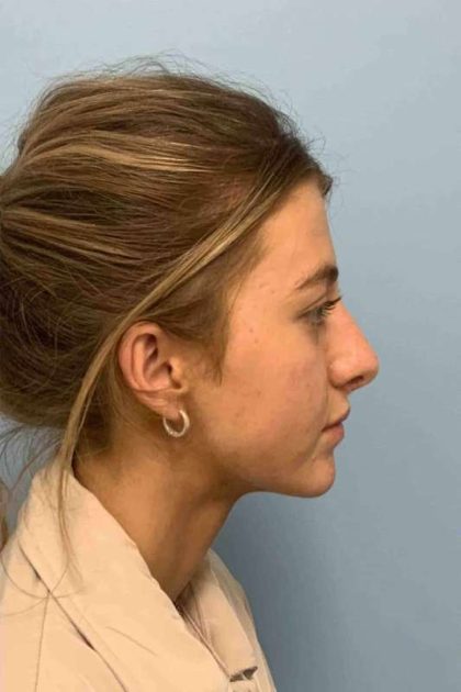 Nose Surgery Before & After Patient #11004