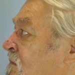 Nose Surgery Before & After Patient #11011