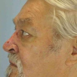 Nose Surgery Before & After Patient #11011