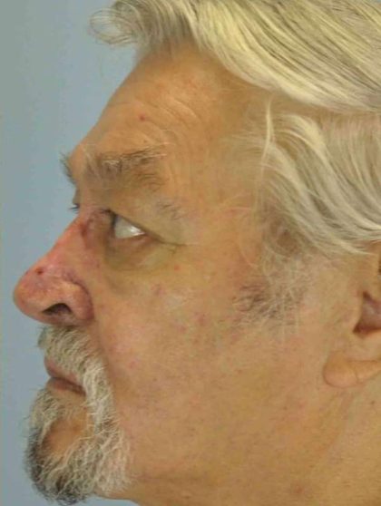 Nose Surgery Before & After Patient #11011