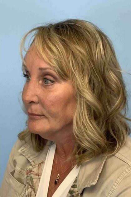 Nose Surgery Before & After Patient #11018