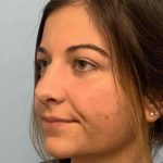 Nose Surgery Before & After Patient #11025