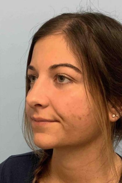 Nose Surgery Before & After Patient #11025