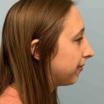 Nose Surgery Before & After Patient #11032